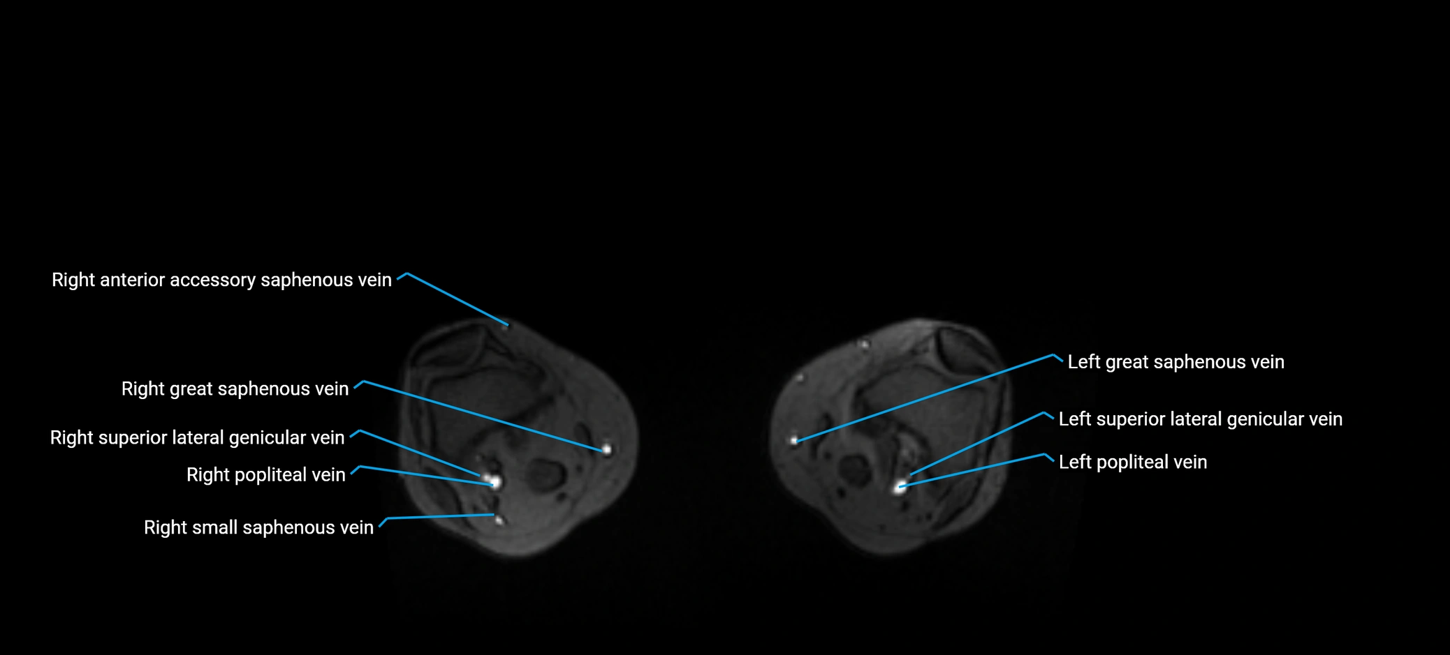 MRV abdomen pelvis & lower limb axial cross sectional anatomy labelled MRI image 356.webp
